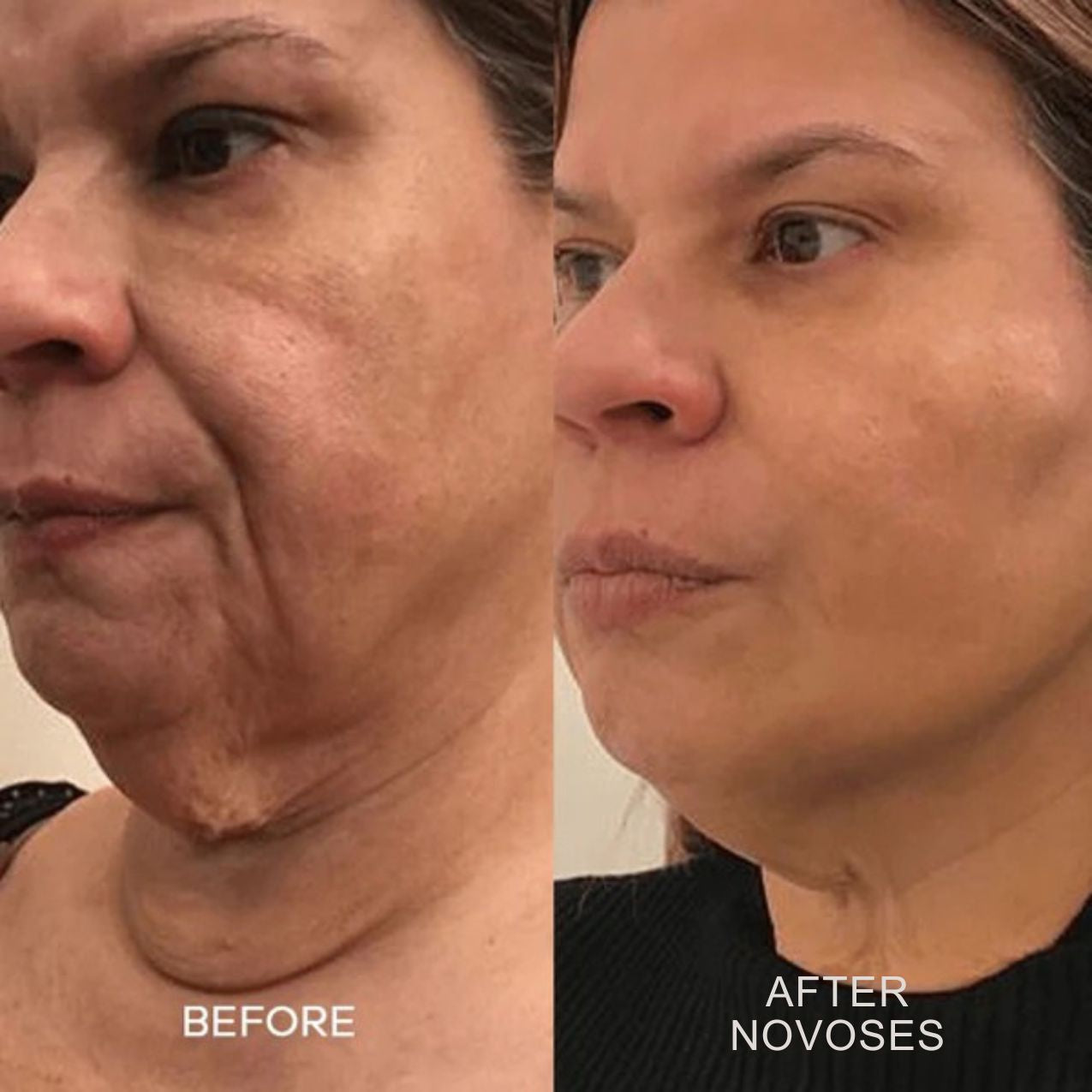 Novoses Micro-Infuse Kit™