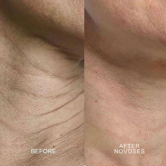 Novoses Micro-Infuse Kit™