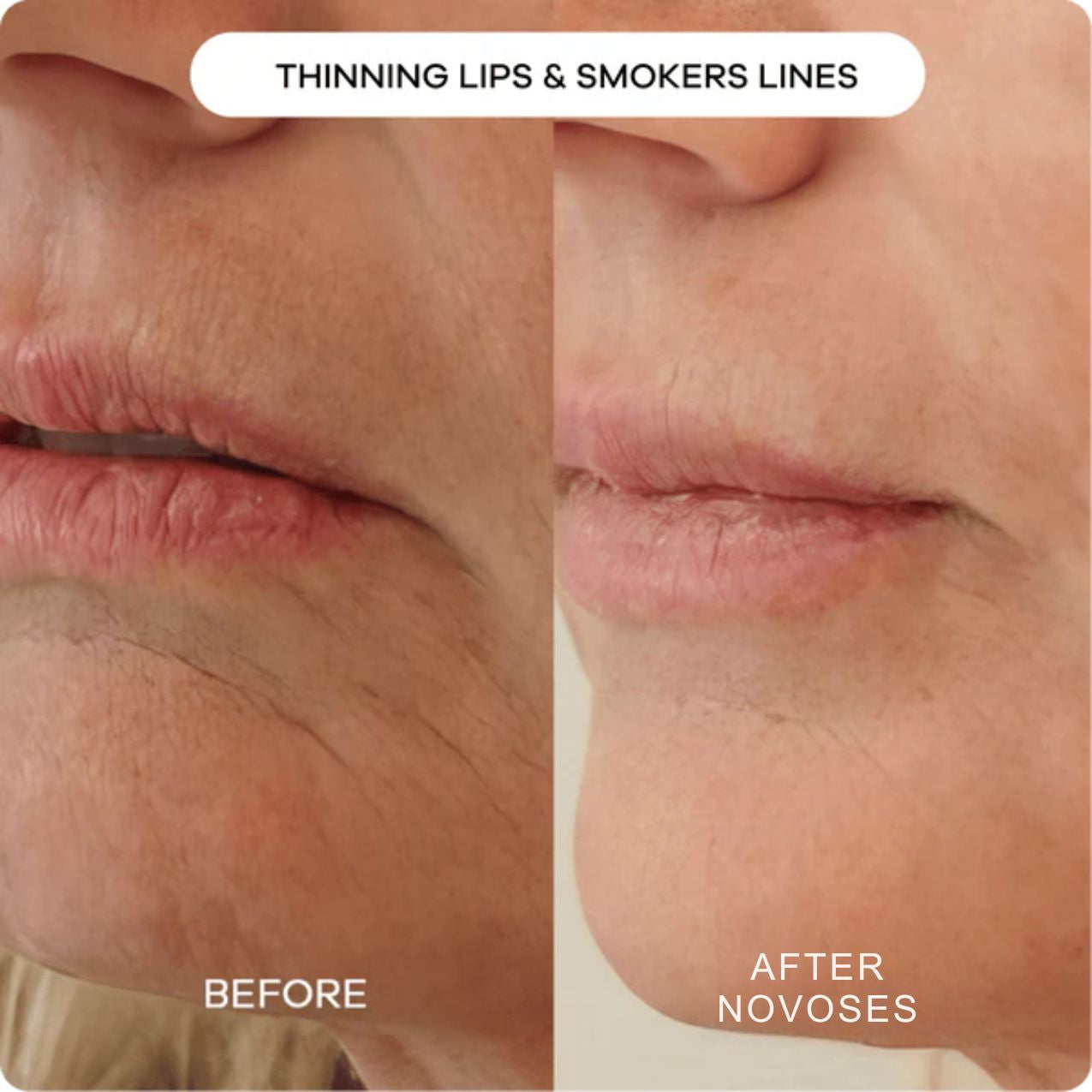 Novoses Micro-Infuse Kit™