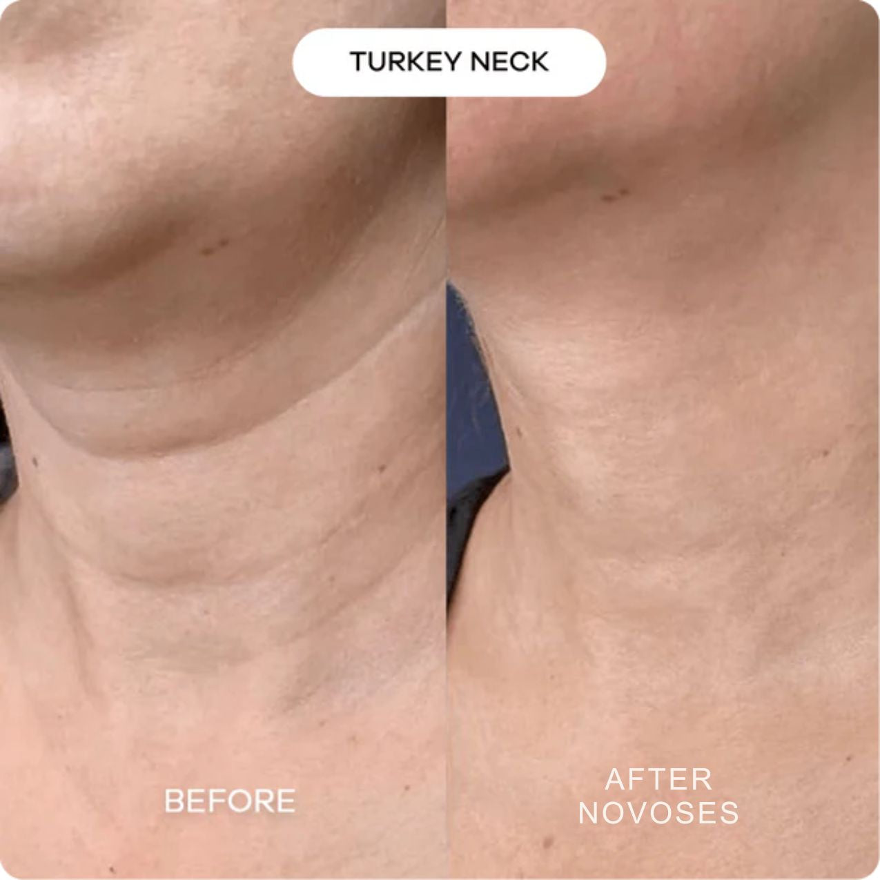 Novoses Micro-Infuse Kit™